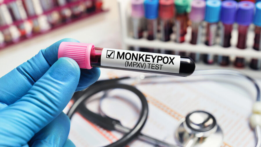 Monkeypox South Africa
