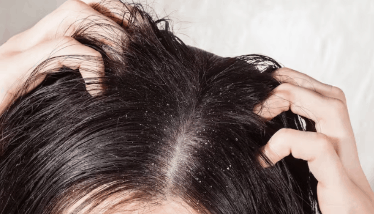 Shutterstock What is dandruff? How do I get rid of it? Why does it keep coming back?