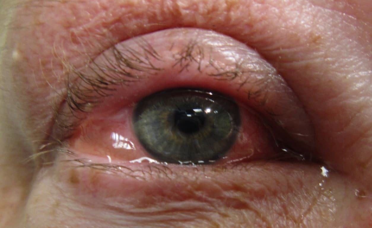 Over 160 cases of Pink Eye confirmed in KwaZulu-Natal
