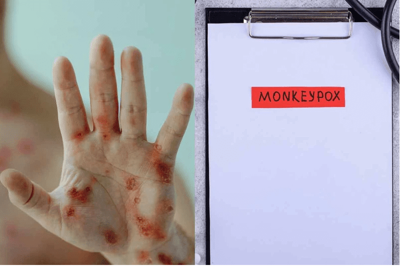 monkeypox symptoms