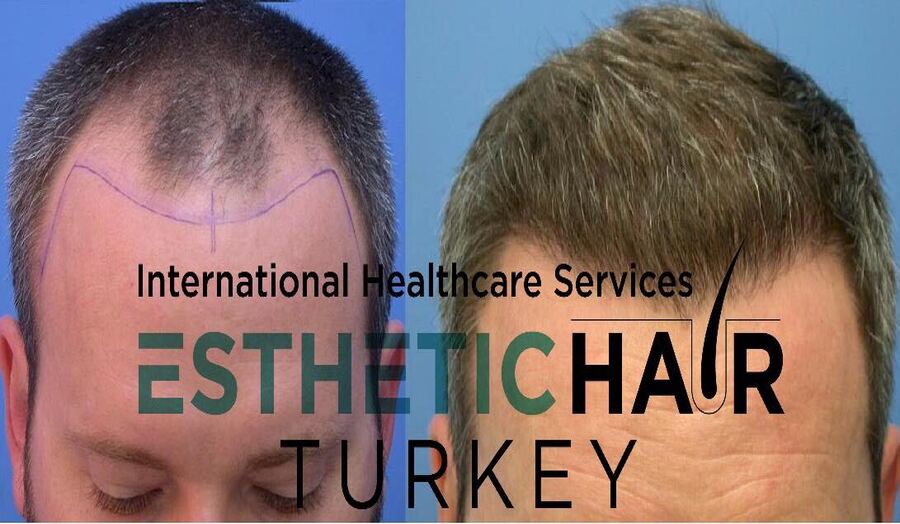 Reclaim your confidence with hair transplants at Esthetic Hair Turkey