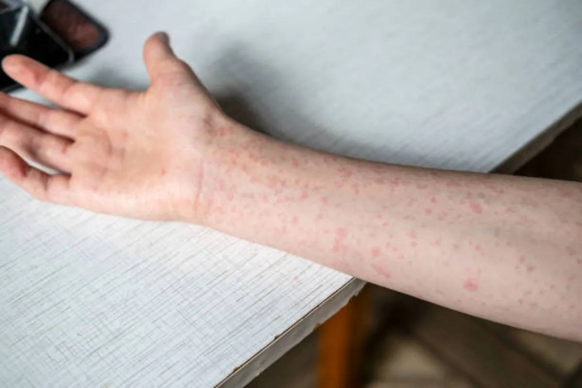 Measles sign.