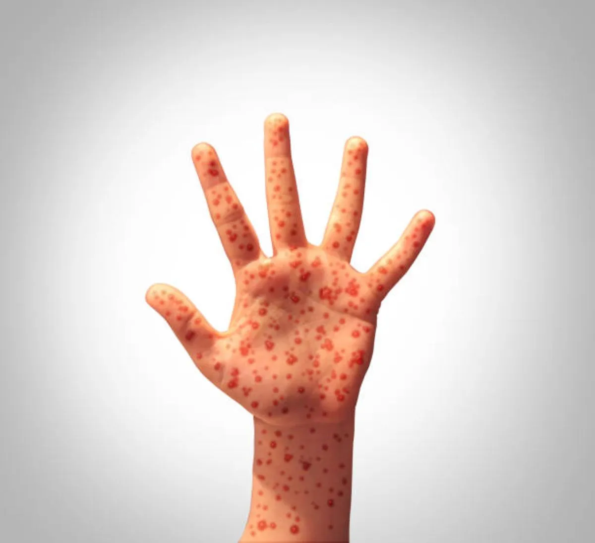 Measles